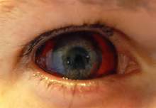 Ebola eye